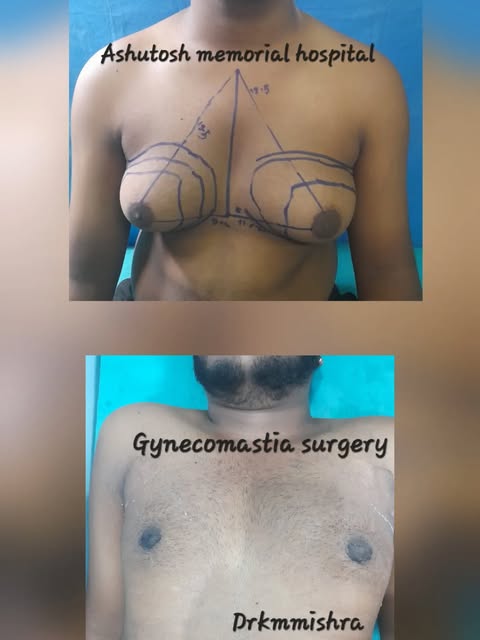 Gynecomastia surgery #Excellent result#Drkmmishra#Ashutoshmemorial #9835447317