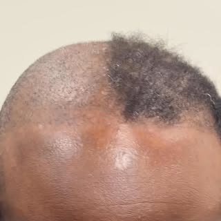 After 3 Failed hair transplants, our client discovered SMP🪄

Smp is life-changing💯

All natural Re