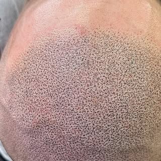 The hair loss struggle is over!

We created a Natural Soft hairline , and added full density🪄

*Smp
