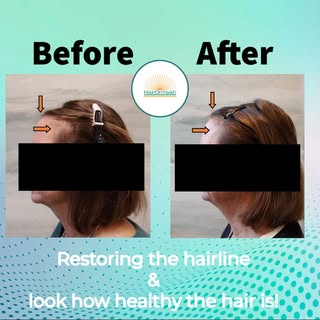 Walk out more confident!
This patient had thinning hair and a disappearing hairline. After just 3 Al