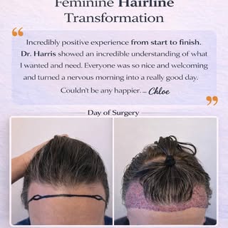#transgender #hairtransplant #transformation #FUE #hairtransformation #FUT #beforeandafter #femaleha