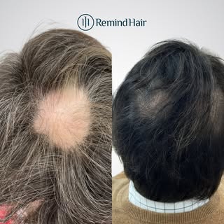 Antes y después de un caso de alopecia areata 

La alopecia areata puede provocar la aparición repen