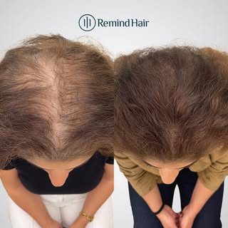 La alopecia androgenética femenina es una patología crónica y progresiva caracterizada por la miniat