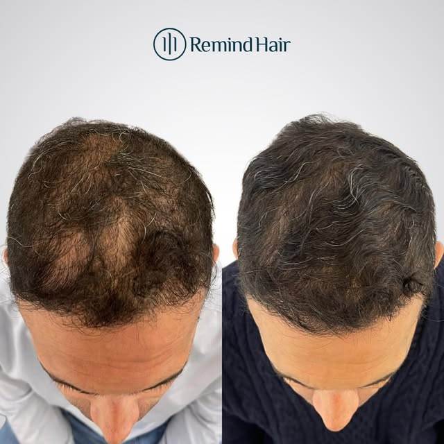 Aquí podemos ver la evolución de un paciente con alopecia androgenética masculina (AGA). 💙

Tras re