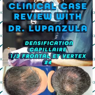 Clinical Case Review with Dr. Emorane Lupanzula #4
Densification capillaire du 1/3 Frontal et du Ve