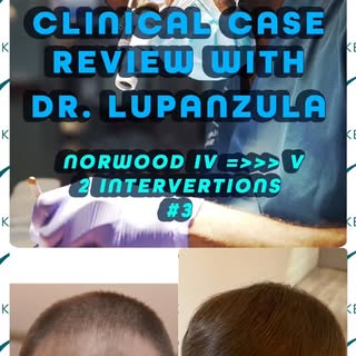 Clinical Case Review with Dr. Emorane Lupanzula #2
Norwood IV vers V– en 2 interventions

Chaque 