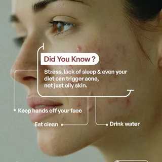 Acne isn’t always about oily skin. 🧴✨
Stress, lack of sleep, diet, and everyday habits can all infl