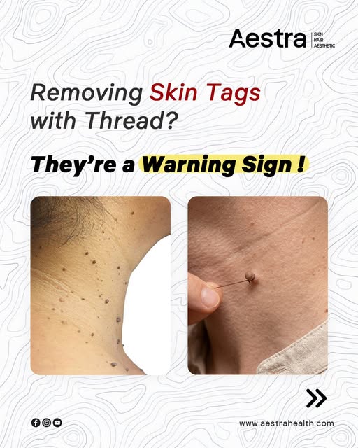 Skin tags are more than just a skin concern. They may be linked to insulin resistance.
Avoid unsafe 