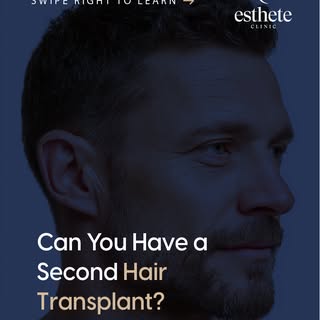 A second hair transplant may be possible — but only if the donor area allows it.
Proper preservation