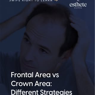 The frontal hairline and the crown require different restoration strategies.
The frontal zone focuse
