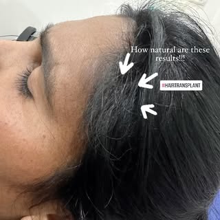 #femalehairtransplant #hairtransplantbangalore #hairgrowthjourney #hairtransplantation
