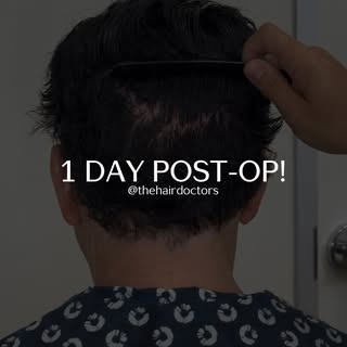 Dr. Nusbaum is here with a no-shave FUE patient just 1 day post-op! See how this advanced technique 