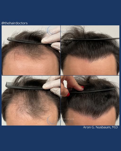 Strip procedure results!  2,712 follicular units transplanted to restore density and create a fuller