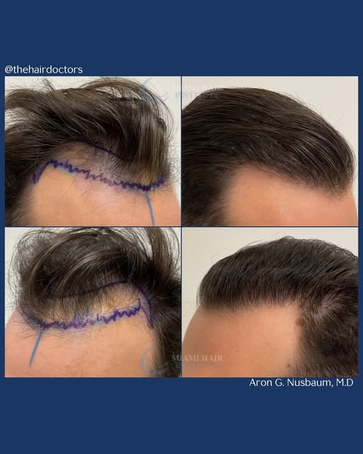 Hybrid FUE results at just 6 months!  This patient had 2,129 follicular units transplanted, and the 