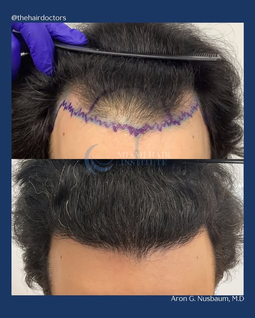 7 months in and the growth is looking amazing! ✨

This patient had 3,026 follicular units transplant