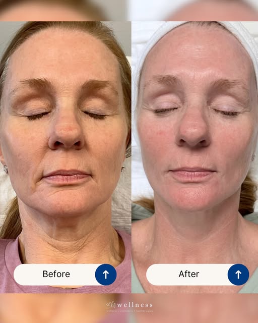 The results speak for themselves.

Virtue RF combines the power of radiofrequency energy and microne