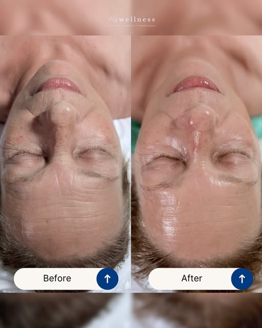 Glass-like skin starts here.

This Glo2Facial Before & After is giving hydrated, smooth, luminous sk