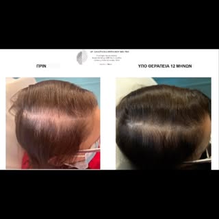 This is the most common hair disease called androgenetic alopecia or female pattern hair loss in wom