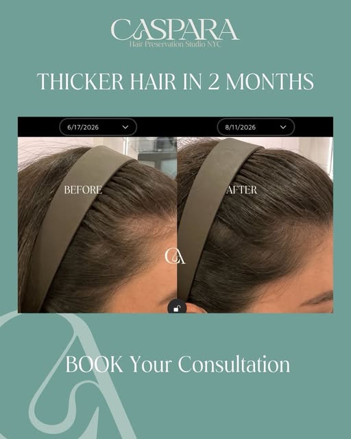 Just 2 months in and the hairline is already thickening. This client is maintaining her hair and wan