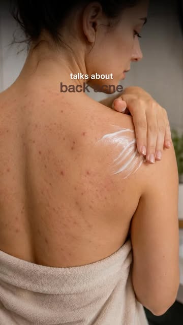 Backless season is around the corner! ✨ Those bumps, breakouts & marks on your back deserve attentio