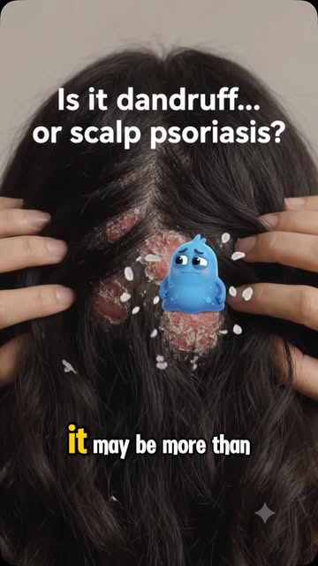 Is it dandruff… or scalp psoriasis? 🤔
If you keep getting persistent flakes, redness, itching or th