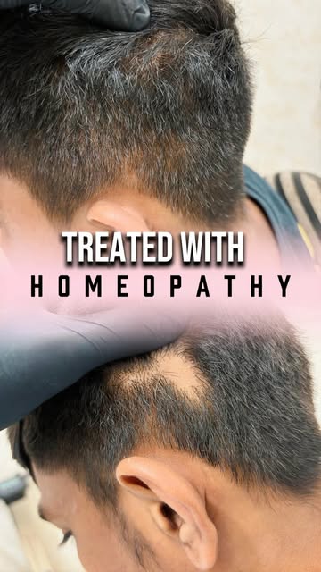 ✨ **From visible patches to visible regrowth. 🌱**

Sharing Mr. Duddhat’s **alopecia areata treatmen