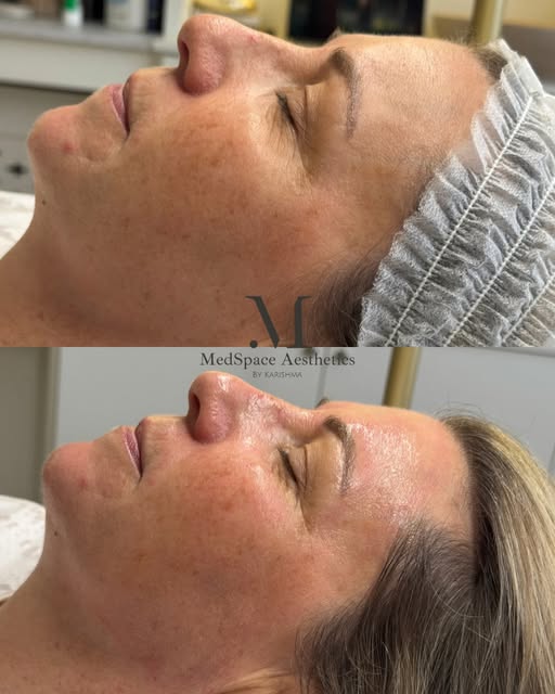 Expecting perfect skin from one treatment, is like expecting a beach body from one workout. Although
