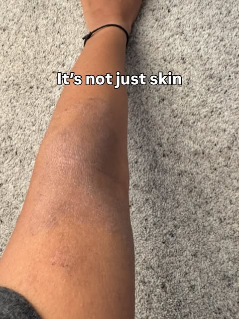 Eczema awareness week 🤍

For years I couldn’t fix my own skin, eczema has affected me in every deca