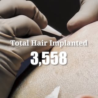 DHI's outstanding results: Discover the exceptional outcomes achieved by DHI ✨

Explore our hair tra