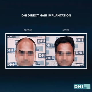Male pattern balding comes in many forms and shapes, but regardless of your condition, hair transpla
