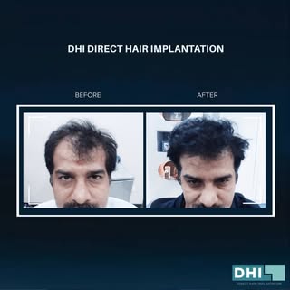 What a world of difference in hair density and hairline rejuvenation.
DM for start your transformati