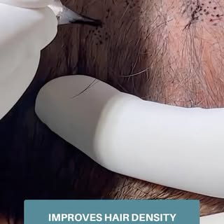 A closer look at how Scalp Micropigmentation helps increase the hair density in your scalp.
*
*
*
#d