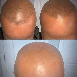 You can’t fix bad ink with more ink.

This client came to us with poorly executed SMP, and the only 