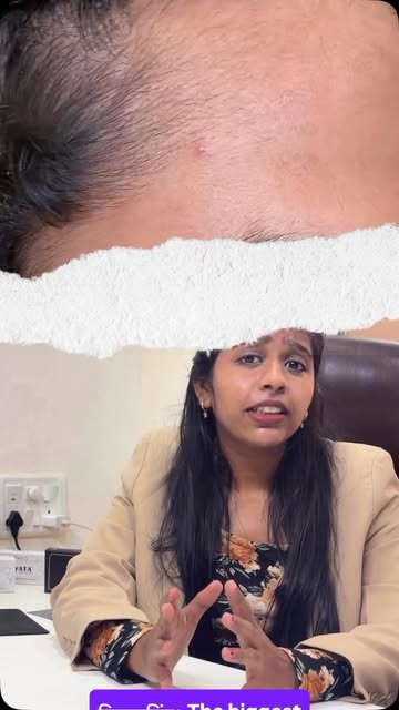 Discover why hairline design is more important than lowering the hairline.
#Hairline #hairtransplant