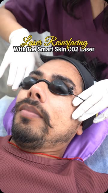 How Does CO₂ Laser Resurfacing Actually Work? 🔥🧴

🔬 CO₂ laser works by creating very precise, con