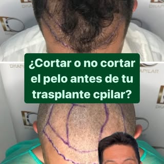 😀Si estás pensando en hacerte un trasplante capilar, hay algo súper importante que debes saber ante