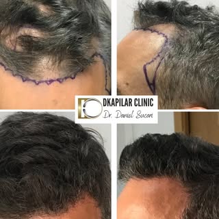 👨‍⚕️Dr. Daniel Sucari ✨Trasplante Capilar FUE-DHI 💯¡Transformación en 7 meses!
✅Presentación del c