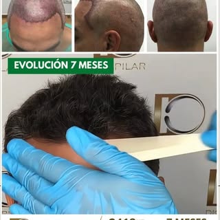 Dr. Daniel Sucari | Trasplante Capilar FUE-DHI: 👏¡Transformación en 7 meses!

📲Escríbenos para age