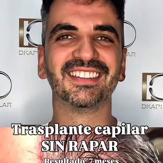 La técnica DHI permite realizar el injerto capilar sin rasurar la zona receptora, manteniendo tu ima