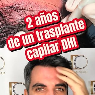 ¿El trasplante capilar termina el día de la cirugía? No. La clave del éxito es el acompañamiento pos