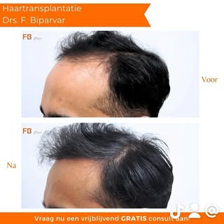 At FB Clinic, great emphasis is placed on creating harmonious facial symmetry through hair transplan