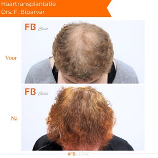 Van dun naar vol: een natuurlijk resultaat op de kruin! ✨

 #Haartransplantatie #FBClinic #haarklini