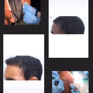 Natural, full hair—designed for curly & coily hair! ✨ At FB Clinic, we specialize in hair transplant