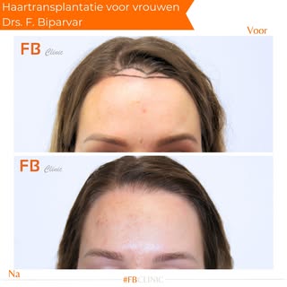 ✨Expert hairtransplants at FB Clinic!

#NatuurlijkeResultaten #hairtransplant #haarlijn #hairtranspl
