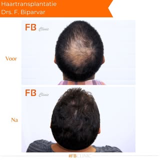 More hair, more style ✨ 

#hairtransplant #haartransplantatie #hair #crown#kruin#kaal#haartransplant