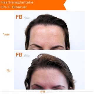 Van hoog naar perfect laag! ✨ Een natuurlijk vollere haarlijn voor een frisse look. 

#Haartransplan