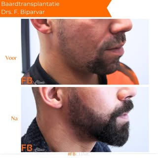 Jouw baard, jouw stijl! 🧔🏽‍♂️ 
Ontdek het verschil met onze baardtransplantatie.

 #haarkliniekrot