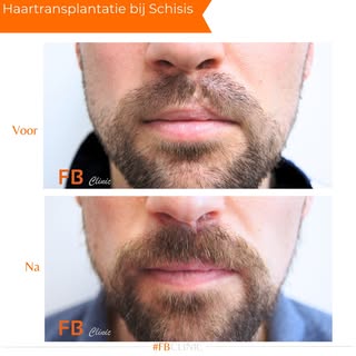 Bij FB Clinic helpen we mannen met een schisis om een vollere, egale baard te krijgen door middel va