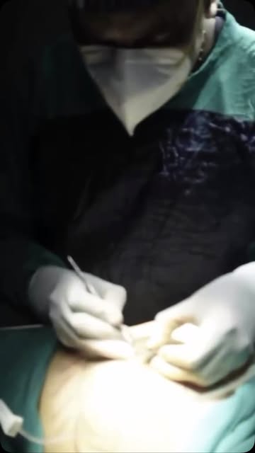 Real Patient Real Result..

#plasticsurgery #drsanjaysoni #plasticsurgeryindia #sculptchest #liposuc