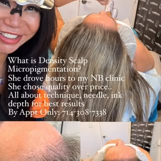 #scalpmicropigmentation #beforeandafter #thinninghairsolution #prpmedicalclinic #hairlosssolution